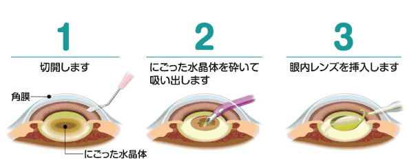 超音波白内障手術